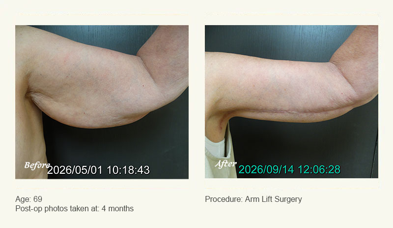 Arm Lift Surgery in Plano, TX - Patient 2