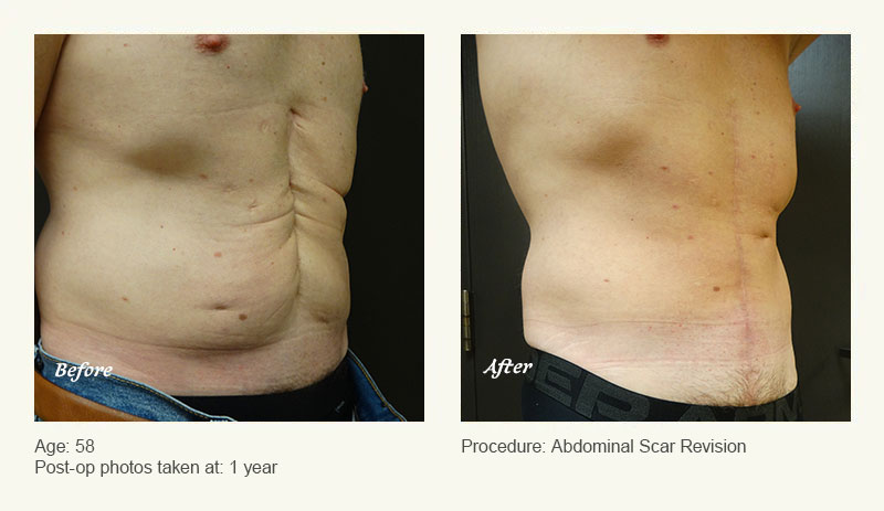 Reconstructive Surgery in Plano, TX - Patient 2