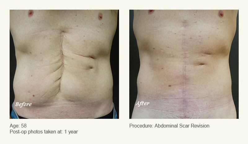 Reconstructive Surgery in Plano, TX - Patient 1