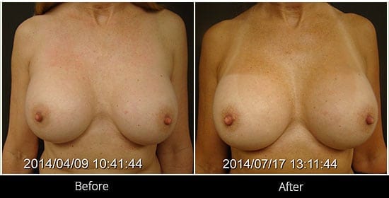 Breast Implant Revision Before & After 8 Front