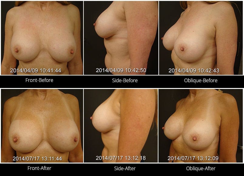 Breast Implant Revision Before & After 8 Full