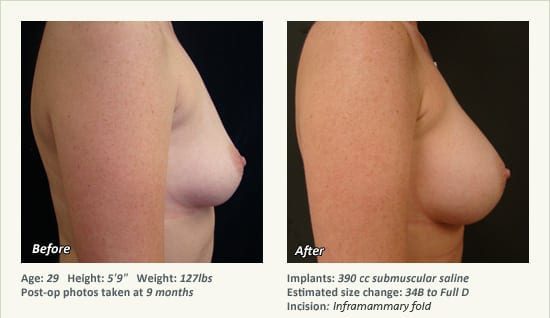 Breast Augmentation in Plano, TX - Patient 106