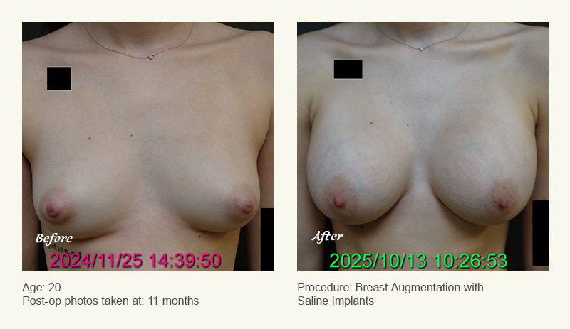 Breast Augmentation in Plano, TX - Patient 1