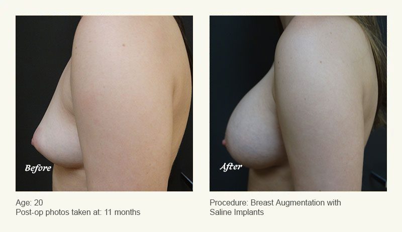 Breast Augmentation in Plano, TX - Patient 2