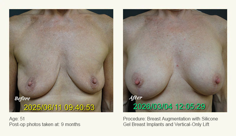 Breast Augmentation With Lift in Plano, TX - Patient 3