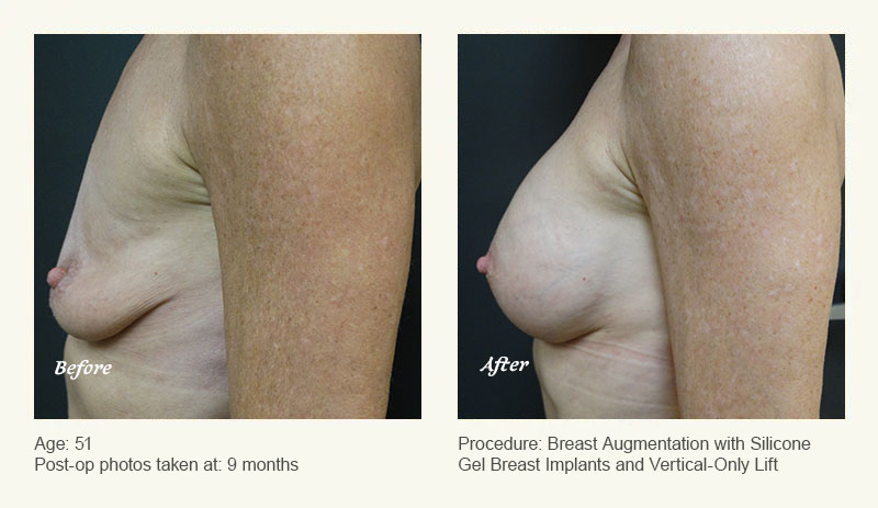 Breast Augmentation With Lift in Plano, TX - Patient 4