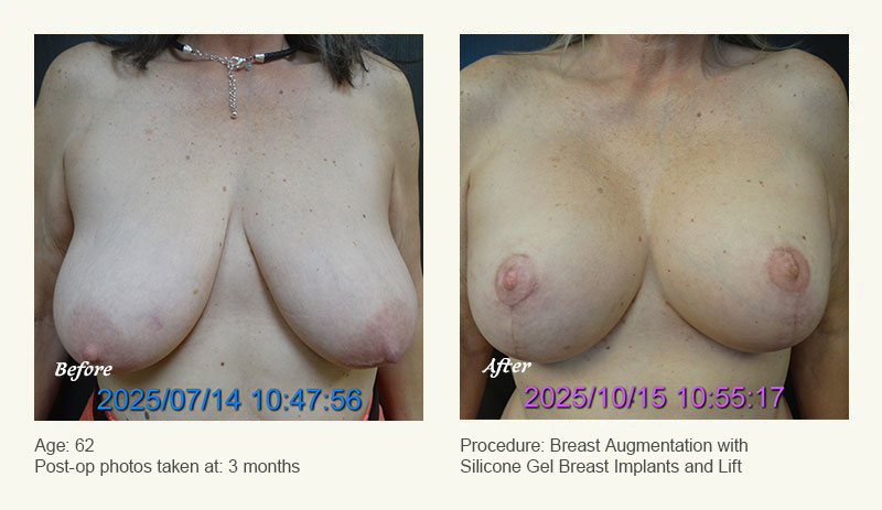 Breast Augmentation With Lift in Plano, TX - Patient 1