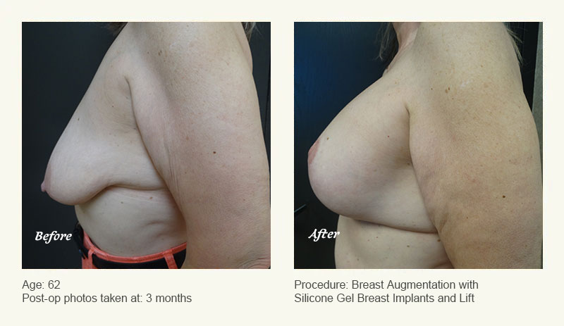 Breast Augmentation With Lift in Plano, TX - Patient 2
