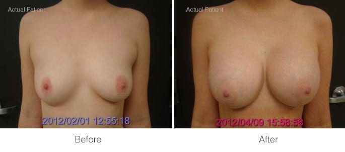 Before and After Breast Augmentation | Ronald M. Friedman