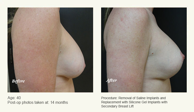 Breast Implant Revision in Plano, TX - Patient 2