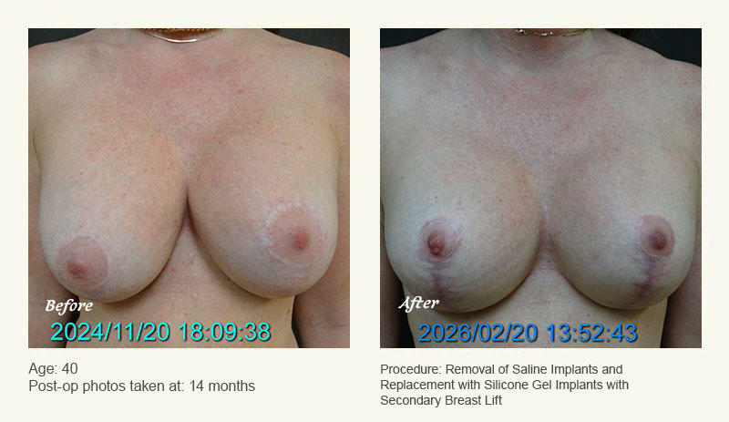 Breast Implant Revision in Plano, TX - Patient 1