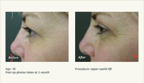 Eyelid Lift Surgery in Plano, TX - Patient 22
