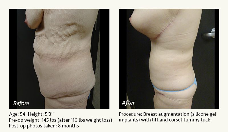 Body Contouring After Weight Loss in Plano, TX - Patient 2