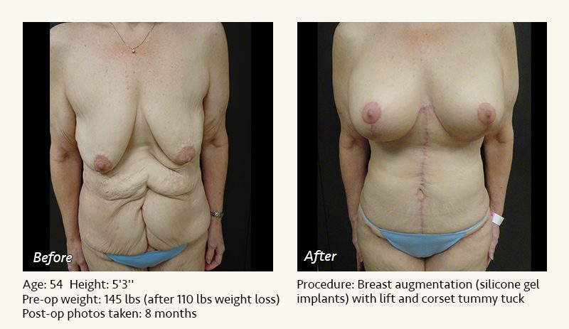 Body Contouring After Weight Loss in Plano, TX - Patient 1