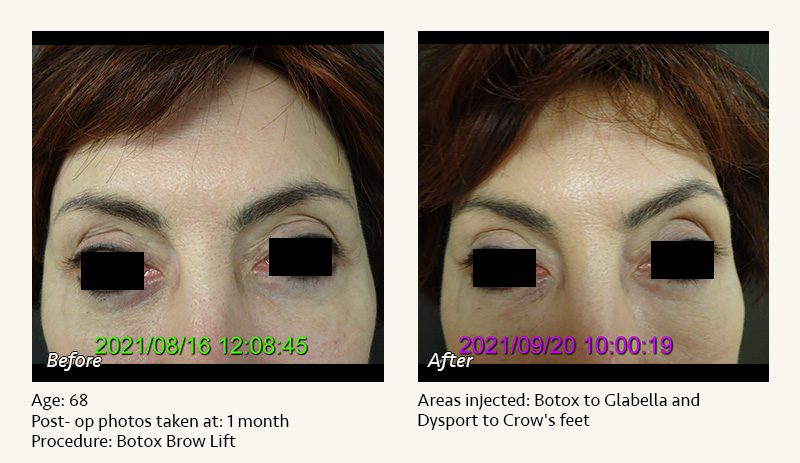 BOTOX® Cosmetic & Dysport® Treatment in Plano & Dallas - Patient 1