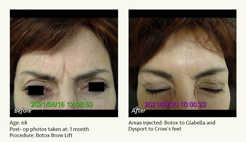 BOTOX® Cosmetic & Dysport® Treatment in Plano & Dallas - Patient 2
