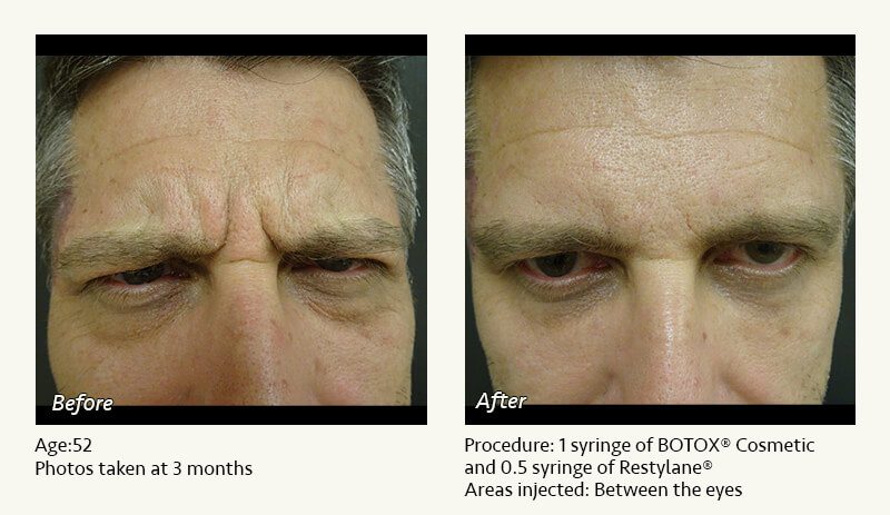 Botox Cosmetic Dysport Treatment In Plano Dallas Tx Ronald Friedman M D