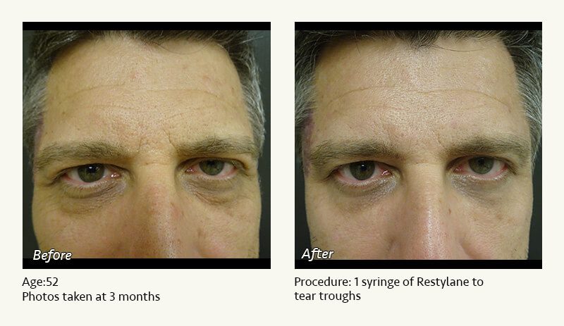 Restylane® & JUVÉDERM® Gel Injectable Fillers In Plano, TX - Patient 20