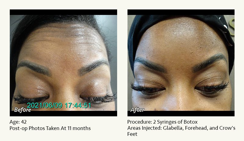 BOTOX® Cosmetic & Dysport® Treatment in Plano & Dallas - Patient 11