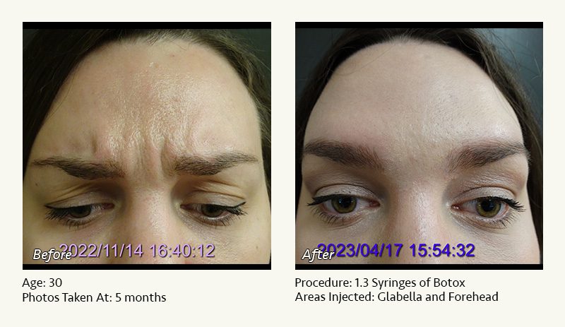 BOTOX® Cosmetic & Dysport® Treatment in Plano & Dallas, TX