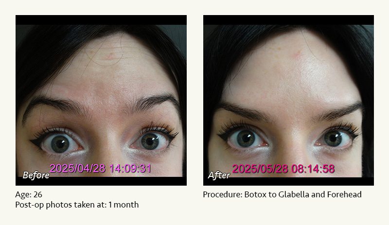 BOTOX® Cosmetic & Dysport® Treatment in Plano & Dallas - Patient 1