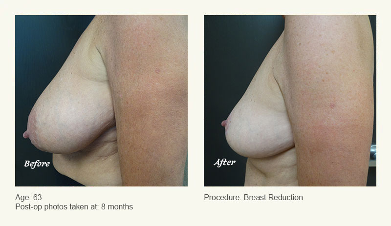 Breast Reduction (Female) in Plano, TX - Patient 2