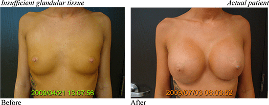 Breast Implant Results 1