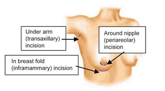 Breast Implant Diagram