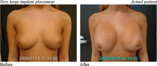 Breast Implant Results 2