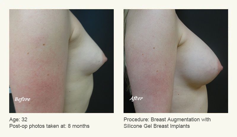 Breast Augmentation in Plano, TX - Patient 4
