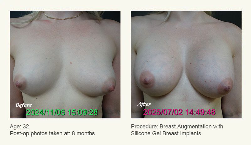Breast Augmentation in Plano, TX - Patient 3