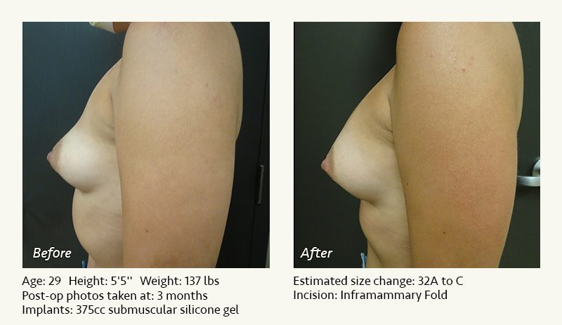 Breast Augmentation in Plano, TX - Patient 52