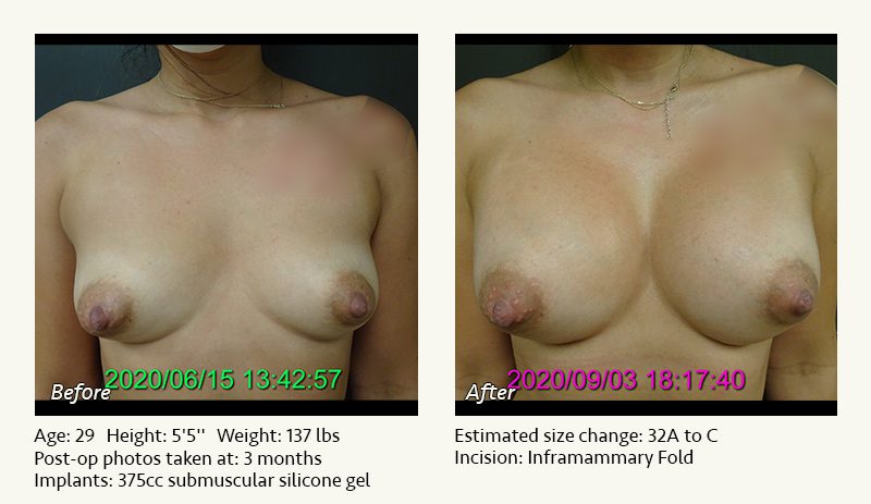 Breast Augmentation in Plano, TX - Patient 51