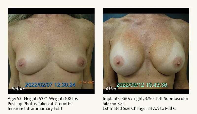 Breast Augmentation in Plano, TX - Patient 43