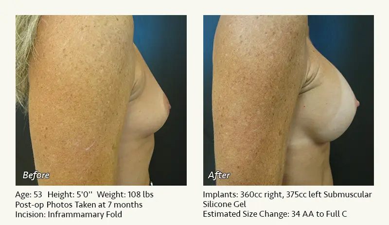 Breast Augmentation in Plano, TX - Patient 44