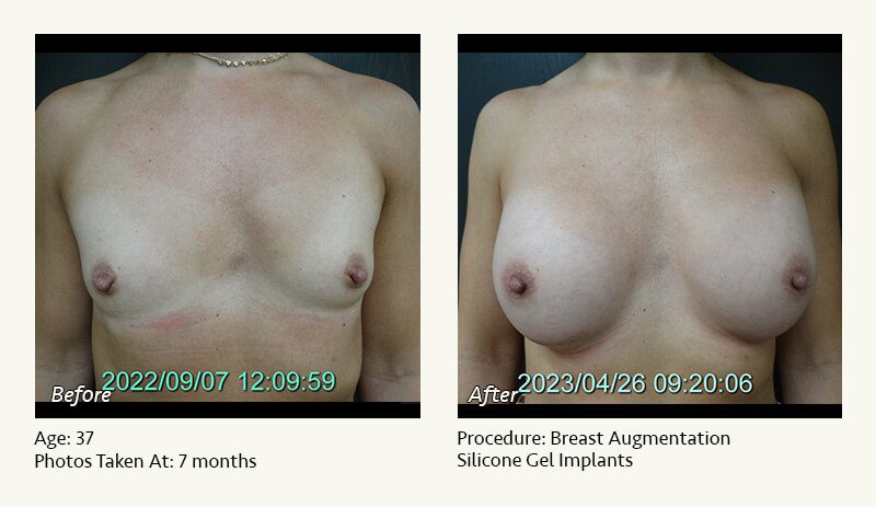 Breast Augmentation in Plano, TX - Patient 39
