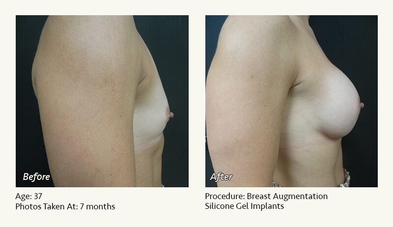 Breast Augmentation in Plano, TX - Patient 40