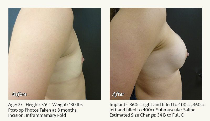 Breast Augmentation in Plano, TX - Patient 42