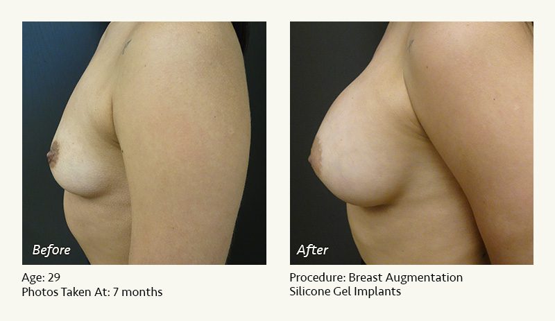 Breast Augmentation in Plano, TX - Patient 38