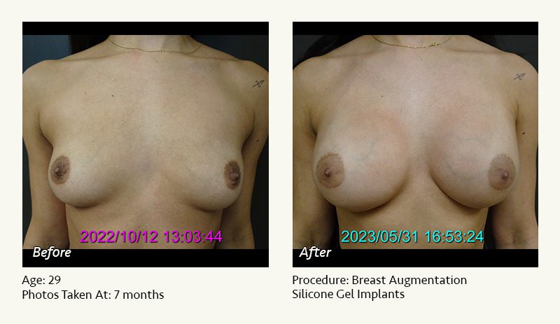 Breast Augmentation in Plano, TX - Patient 37