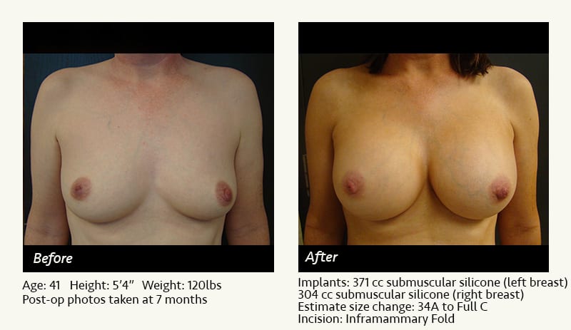 Breast Augmentation in Plano, TX - Patient 81