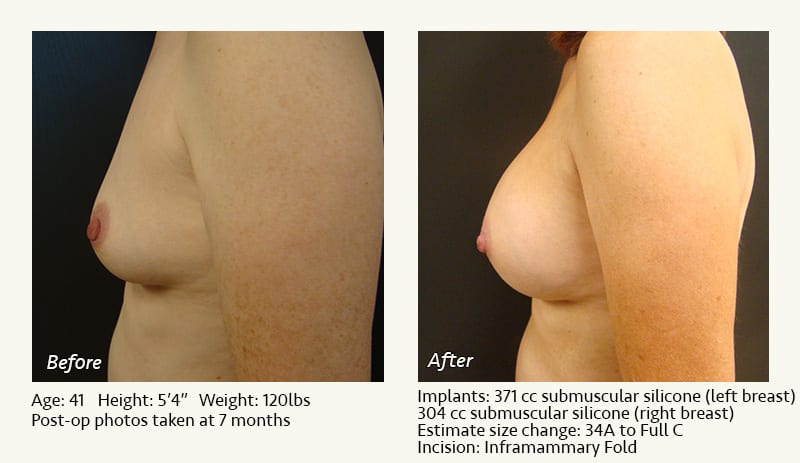 Breast Augmentation in Plano, TX - Patient 82