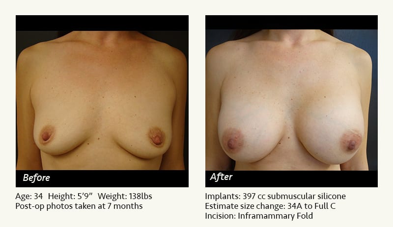 Breast Augmentation in Plano, TX - Patient 83