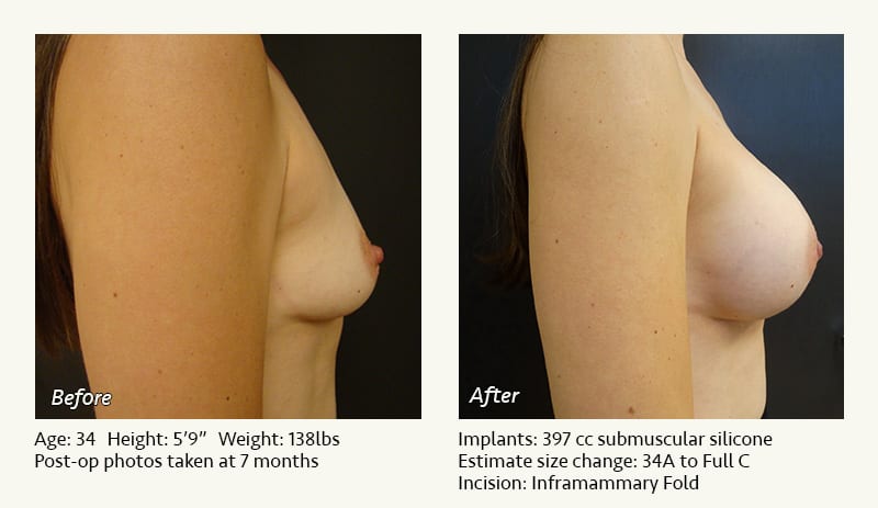 Breast Augmentation in Plano, TX - Patient 84