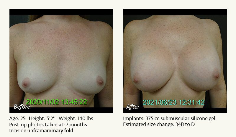 Breast Augmentation in Plano, TX - Patient 49