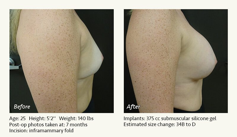 Breast Augmentation in Plano, TX - Patient 50