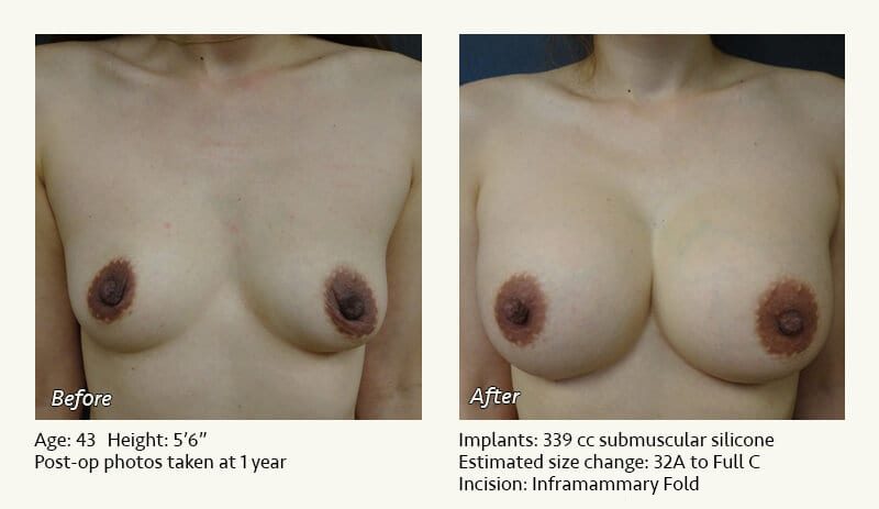 Breast Augmentation in Plano, TX - Patient 117