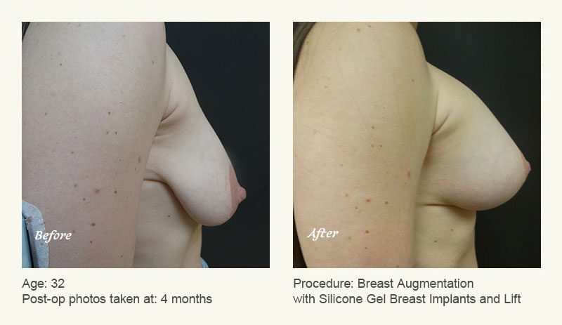 Breast Augmentation With Lift in Plano, TX - Patient 2
