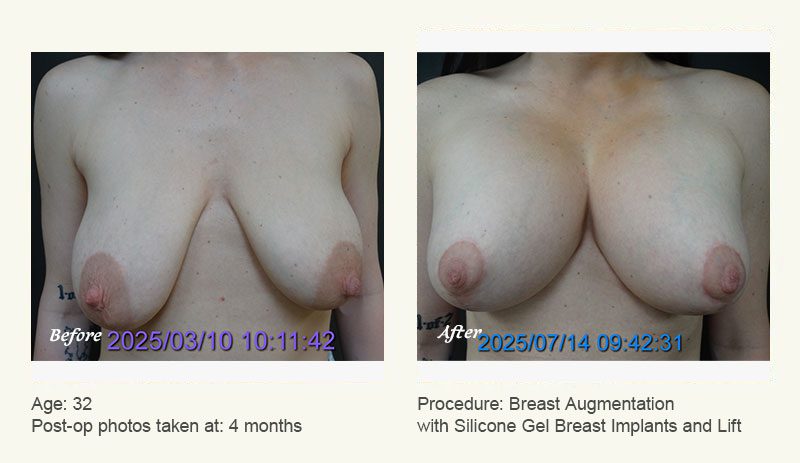 Breast Augmentation With Lift in Plano, TX - Patient 1