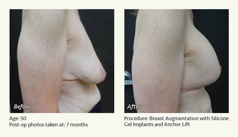 Breast Augmentation With Lift in Plano, TX - Patient 4